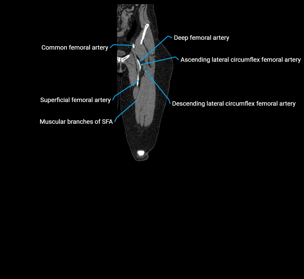 CTA lower limb coronal cross sectional anatomy labelled image _17 (2).webp